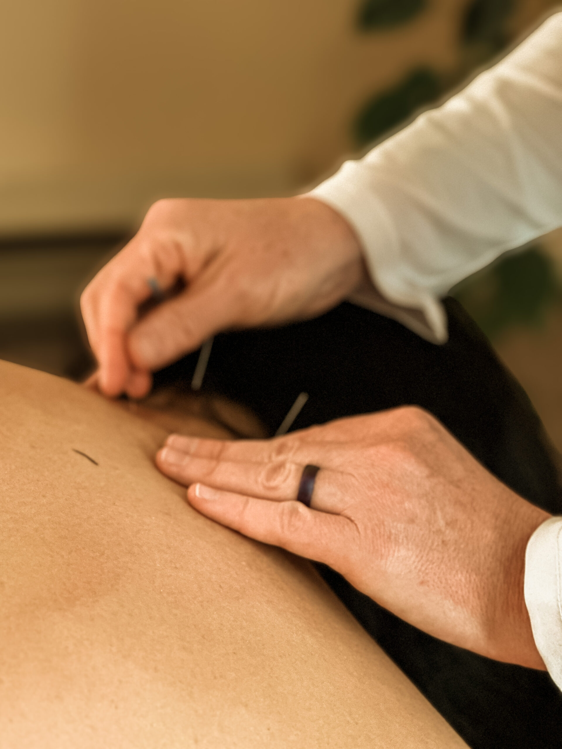 Evergreen acupuncturist performing acupuncture on a patient