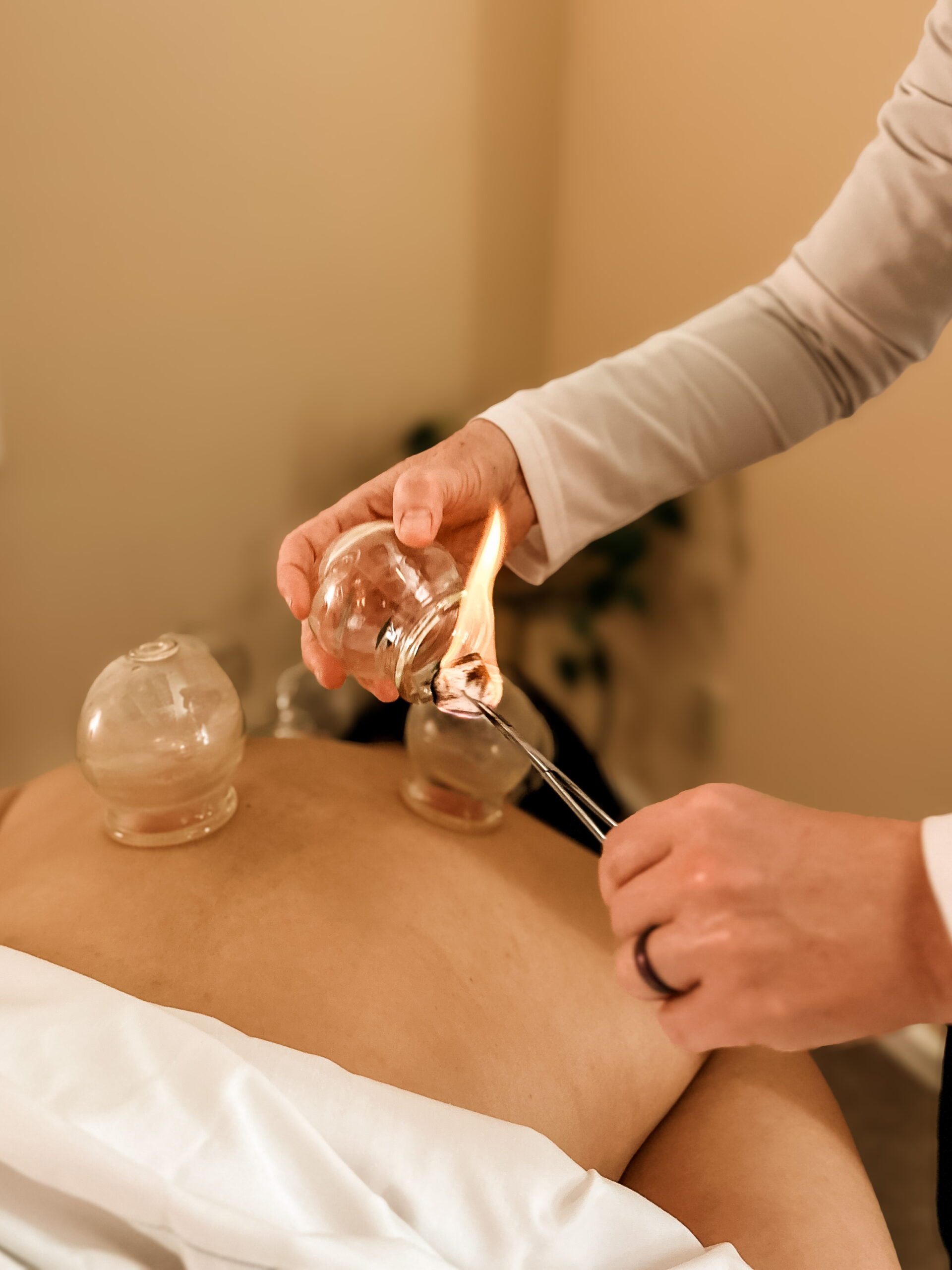 Evergreen Coos Bay Acupuncturist performing cupping on a patient